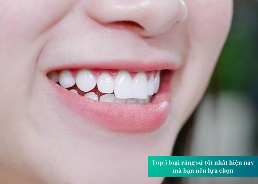 Top 5 loại răng sứ tốt nhất hiện nay mà bạn nên lựa chọn