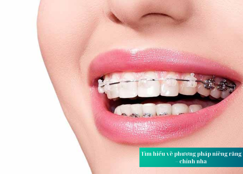 Tìm hiểu về phương pháp niềng răng – chỉnh nha