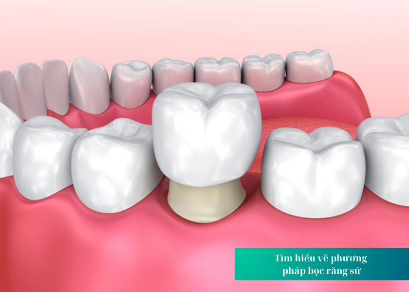 Tìm hiểu về phương pháp bọc răng sứ