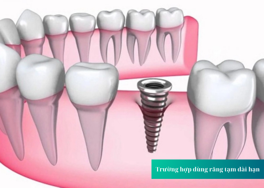 Trường hợp dùng răng tạm dài hạn