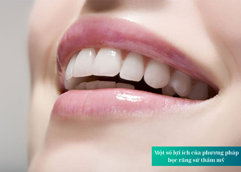 Một số lợi ích của phương pháp bọc răng sứ thẩm mỹ