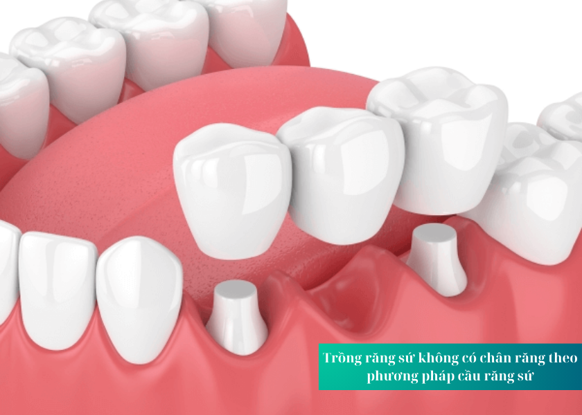 Trồng răng sứ không có chân răng theo phương pháp cầu răng sứ