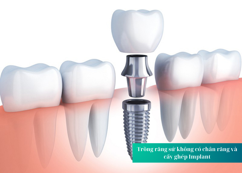 Trồng răng sứ không có chân răng và cấy ghép Implant