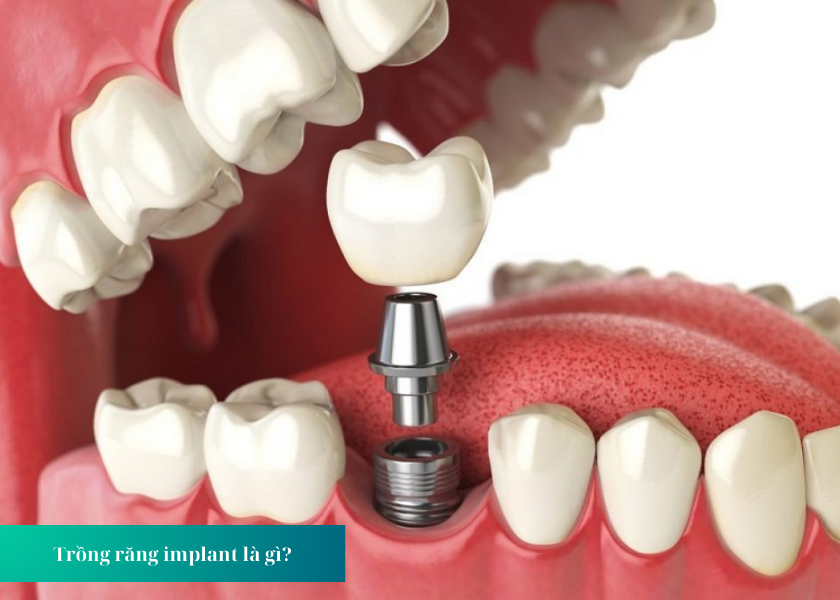 Cấy Ghép Răng Implant Mất Bao Lâu?