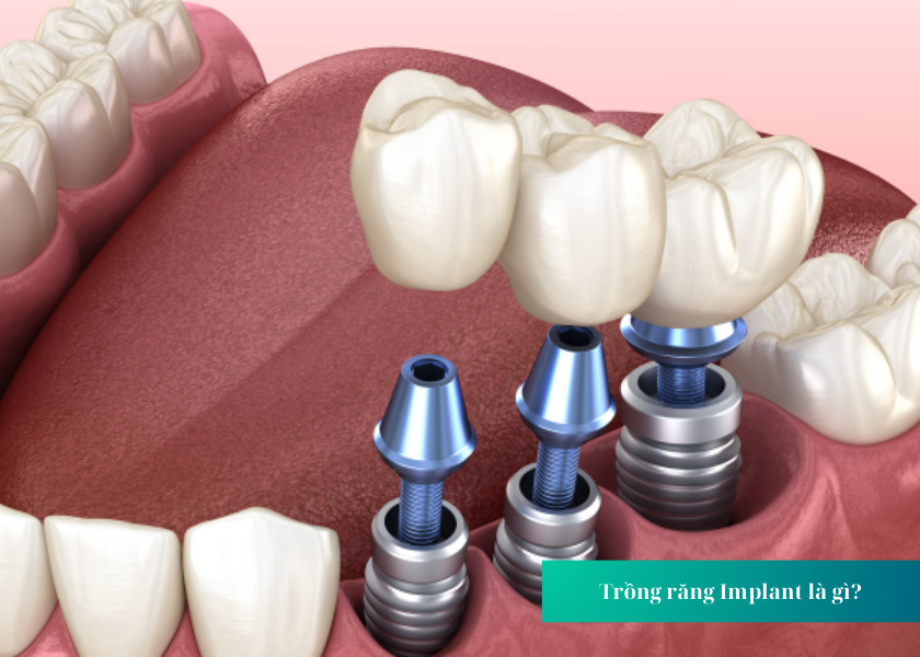 Trồng răng implant có tốt không? Lưu ý gì khi thực hiện trồng răng Implant?