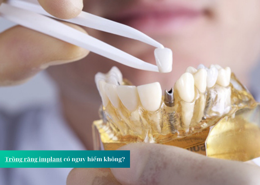 Cấy Ghép Răng Implant Mất Bao Lâu?