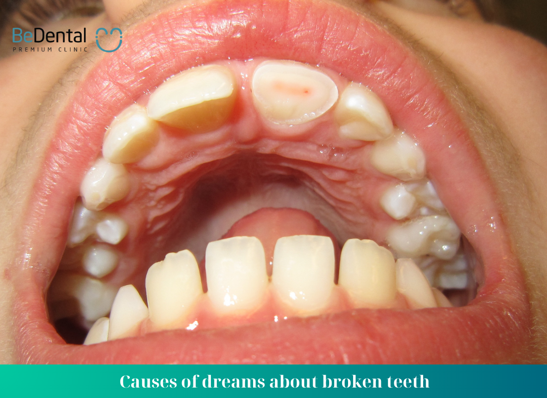 Causes of dreams about broken teeth