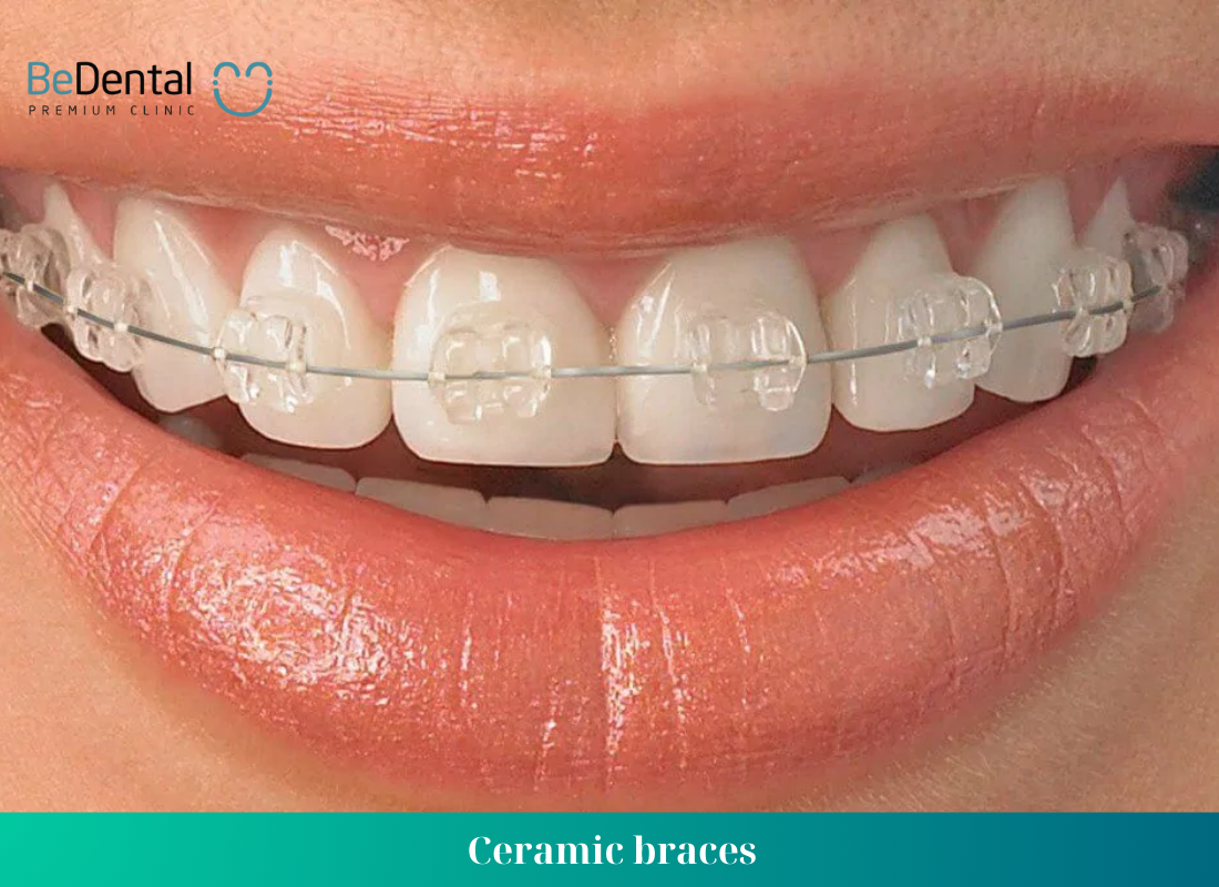 What methods are used for correcting misaligned teeth ?  Ceramic braces