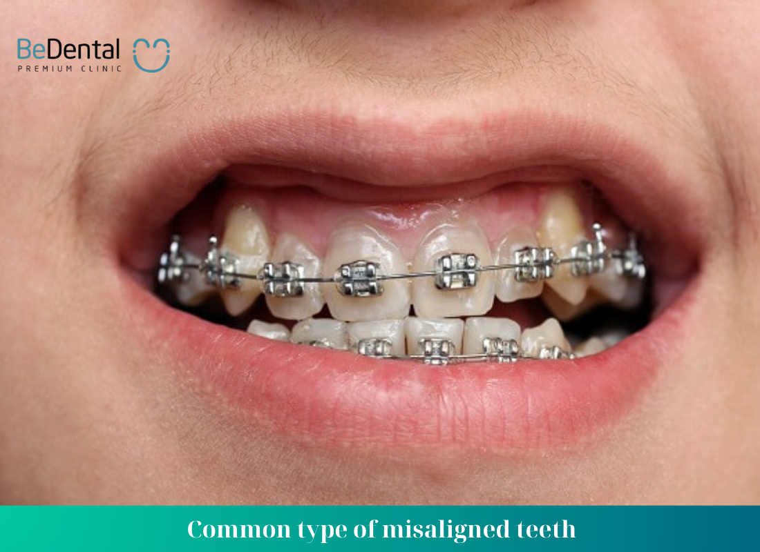 Common type of misaligned teeth