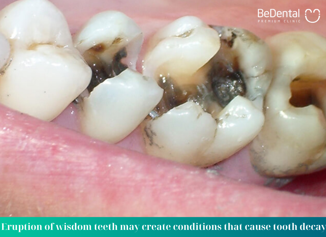 Eruption of wisdom teeth may create conditions that cause tooth decay