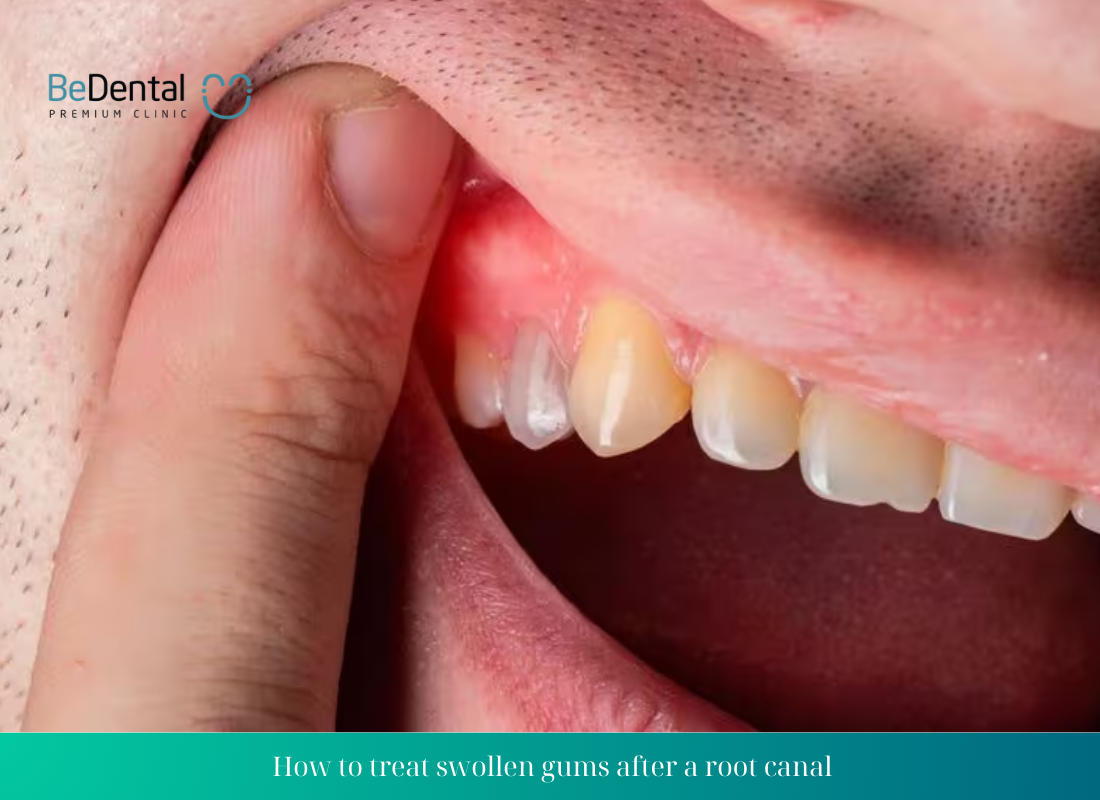 How to treat swollen gums after a root canal?