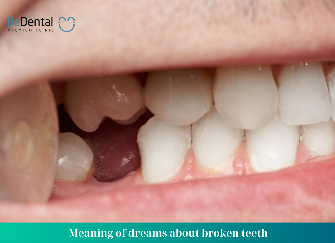 Meaning of dreams about broken teeth
