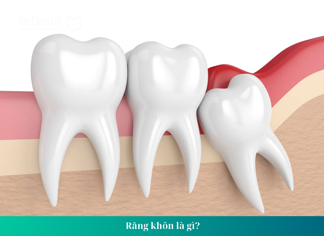 Răng khôn mọc lệch nhưng không đau có nên nhổ không ?