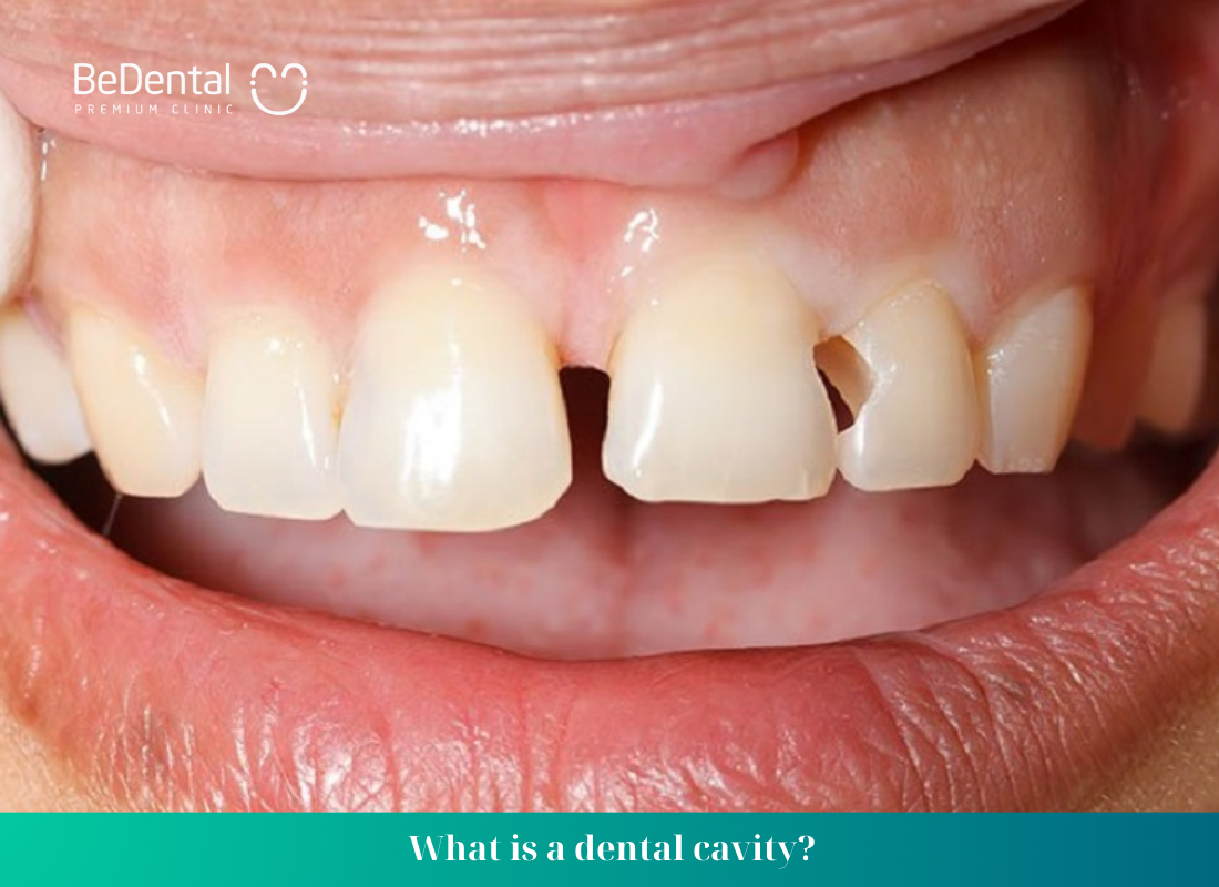 What is a dental cavity?