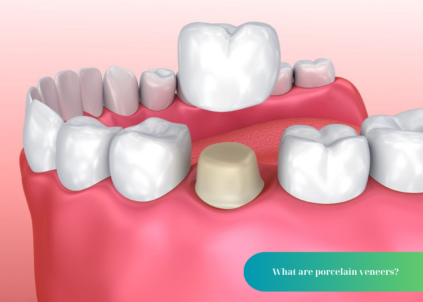 How much does teeth whitening cost 25