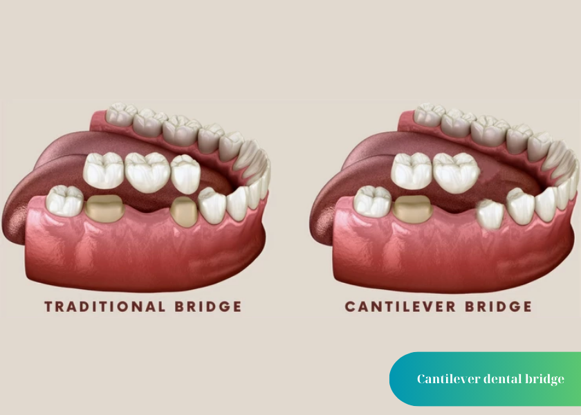 How much does teeth whitening cost 3 1