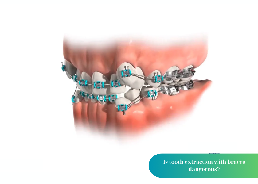 How much does teeth whitening cost 35