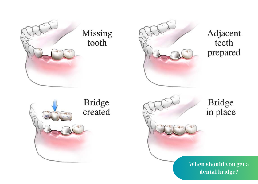 How much does teeth whitening cost 4 1