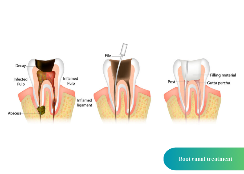 6+ effective ways to treat tooth decay