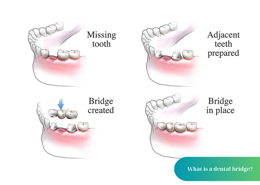 types of dental bridges