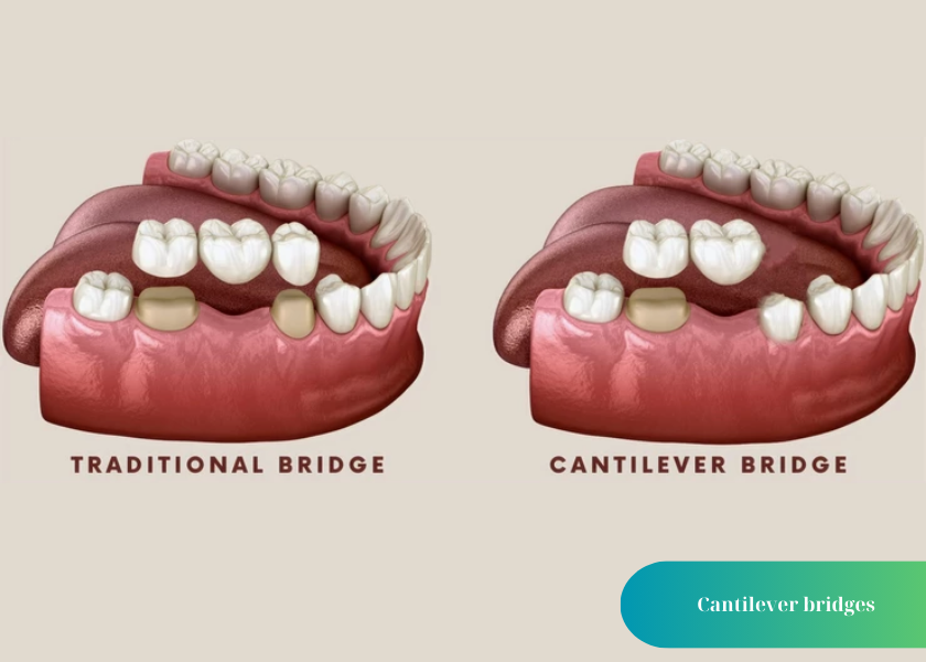 How much does teeth whitening cost 7