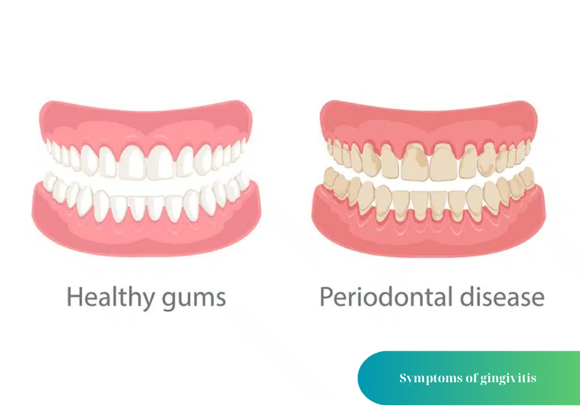 How much does teeth whitening cost 8 min 2