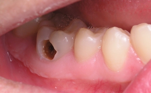 Trám răng sâu có bền không 1