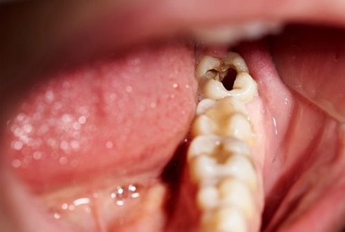 Trám răng sâu có bền không 2