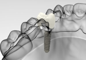 Trồng răng implant Osstem là gì
