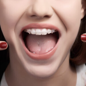 lựa chọn nha khoa bedental để niềng răng mắc cài sứ