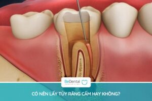 Tùy từng trường hợp mà bác sĩ sẽ chỉ định rút tủy răng cấm hay không