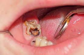 Cách điều trị lỗ sâu răng bị thủng lỗ vào tủy hiệu quả