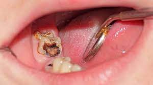 Nguyên nhân sâu răng hàm là gì và cách chữa trị hiệu quả