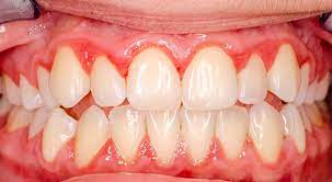 Làm cầu răng sứ hay bị viêm lợi là do đâu và cách điều trị