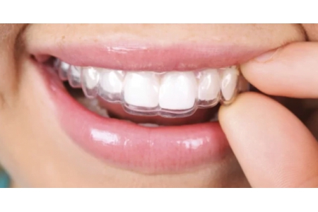 Niềng răng trong suốt có đau nhức không?Giá bao nhiêu?