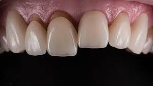 Cầu răng sứ cũ hỏng cần phải làm gì?Nguyên nhân cầu răng hỏng