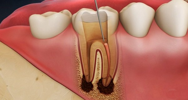 Viêm tủy răng cấm là gì? Có nghiêm trọng không?