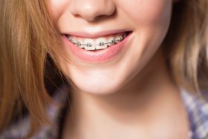Những trường hợp nào thì cần nên niềng răng?