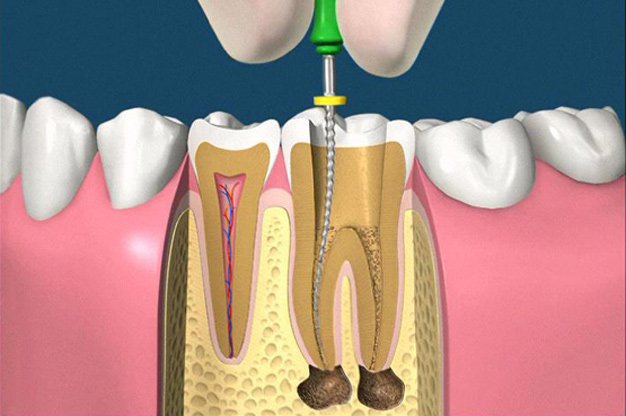 Lấy tủy răng cấm có đau không?