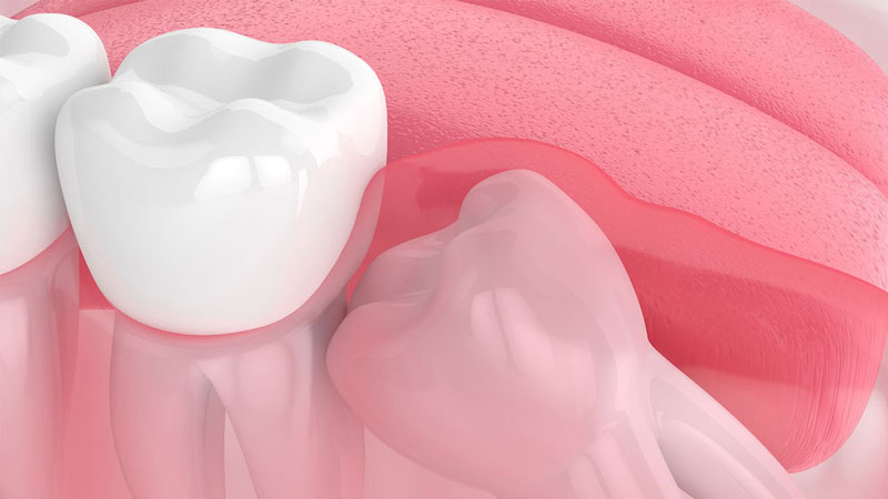 Thường tình trạng đau sau nhổ răng sẽ mất khoảng 2-3 ngày