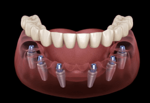 Nhược điểm của cấy răng implant
