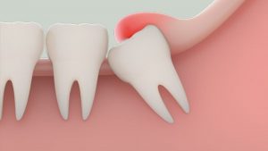 Răng khôn – Răng số 8