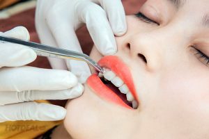 Phương pháp đính kim cương lên răng không khoan lỗ
