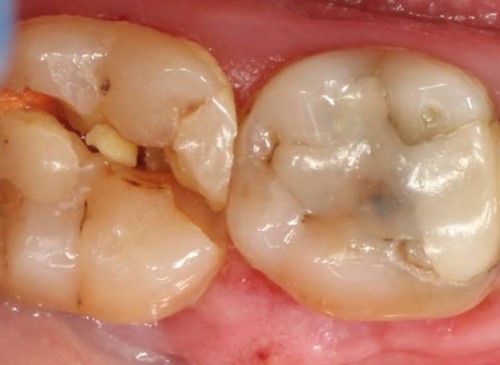 Răng cấm bị vỡ ,mẻ phải khắc phục như thế nào?