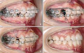 Siết răng khi niềng là gì?Cách giảm đau khi niềng răng