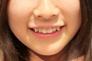 Răng khểnh là chiếc răng số 3 bị mọc sai lệch theo một cung độ và kiến tạo vẻ đẹp duyên dáng cho nụ cười