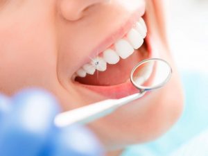 Quy trình đính đá răng gồm 6 bước chính