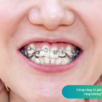 Niềng răng có cần nhổ răng không? Nhổ răng nguy hiểm không? Trường hợp nào không cần nhổ răng?