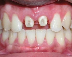 Khi răng giả rơi bụng, bạn nên quan sát phân, theo dõi trạng thái cơ thể và tới bác sĩ để thăm khám