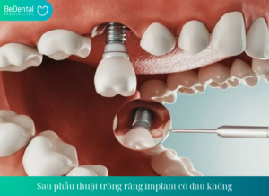 Sau phau thuat trong rang implant co dau khong